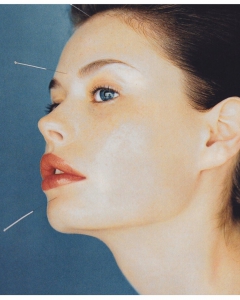 What facial acupuncture give benefits to your beauty?