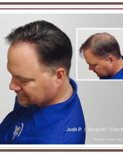 The latest hair loss treatment solution