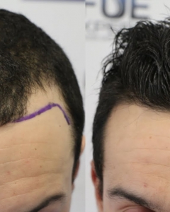 How To Fight Hair Loss Effectively?