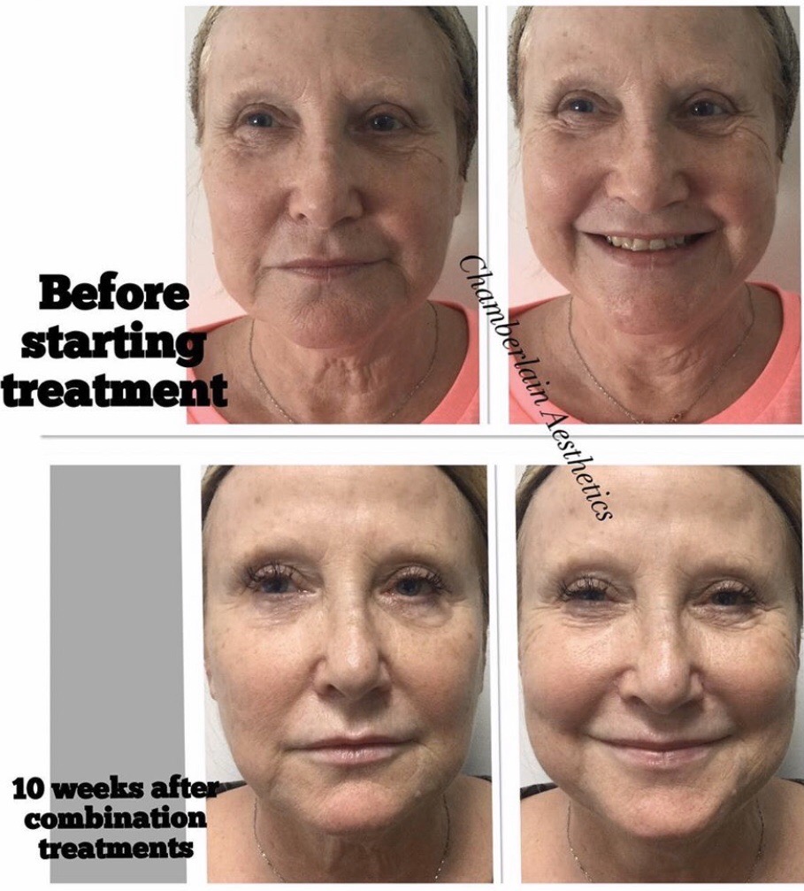 Aesthetic treatment trends for 55+ age group