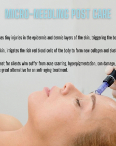 MICRO-NEEDLING FOR ACNE SCARS: 5 THINGS TO KNOW