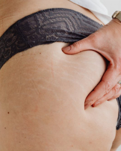 What Causes Stretch Marks on Butt?
